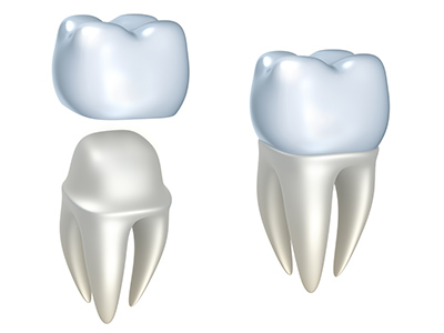 Illustration of a dental crown over a tooth